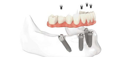 All on Dental Implants